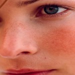 rosacea face