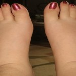 Home remedies to get rid of legs swelling