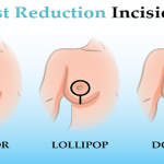 breast enlargement6