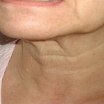 wrinkles at neck